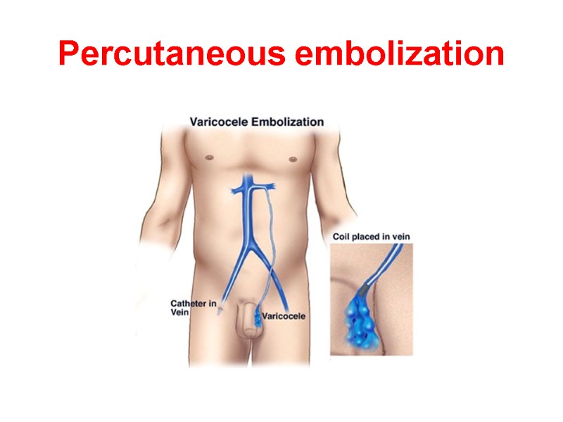 Percutaneous embolization